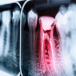 X-ray of toothache in Melbourne