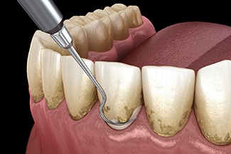 Scaling and root planing can protect your teeth and gums from oral bacteria deposits