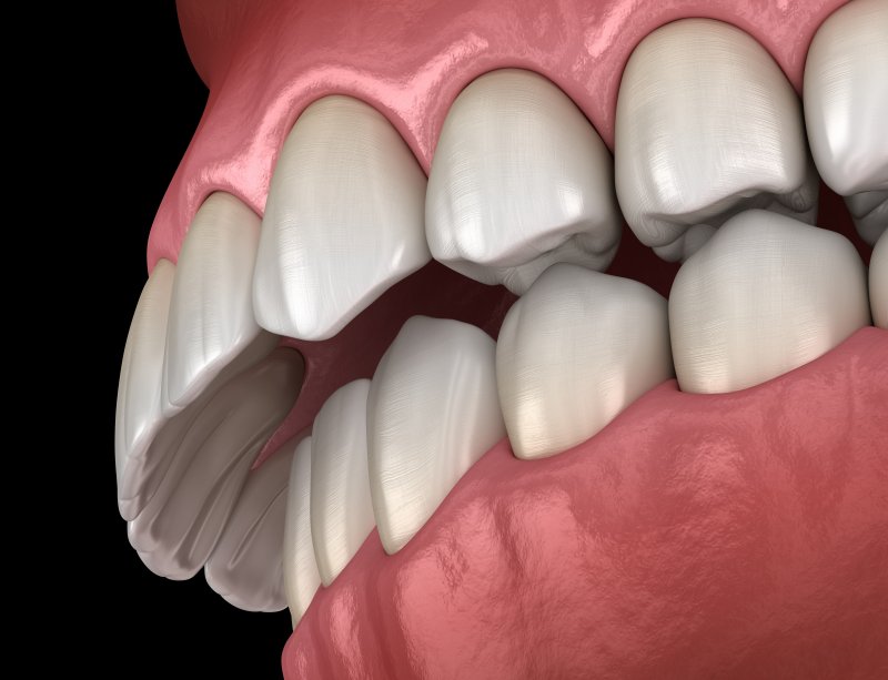 A 3D illustration of an overbite